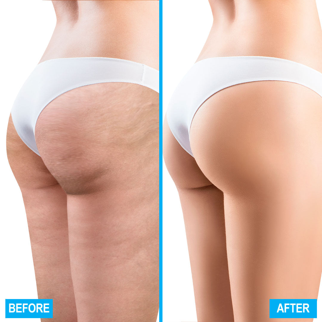 CelluD Anti Cellulite Topical